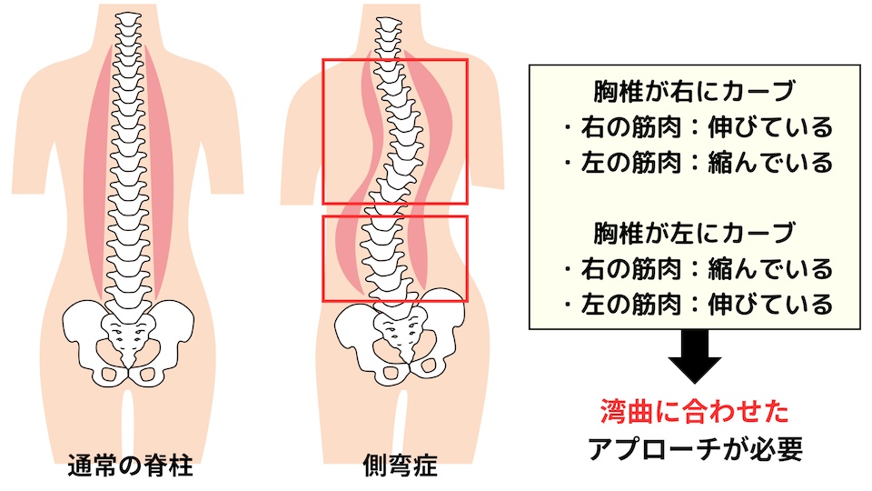 側弯症のアプローチ